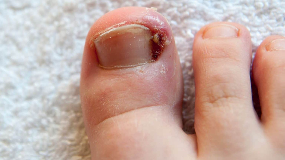 Understanding Ingrown Toenails in Babies: A Guide for Parents